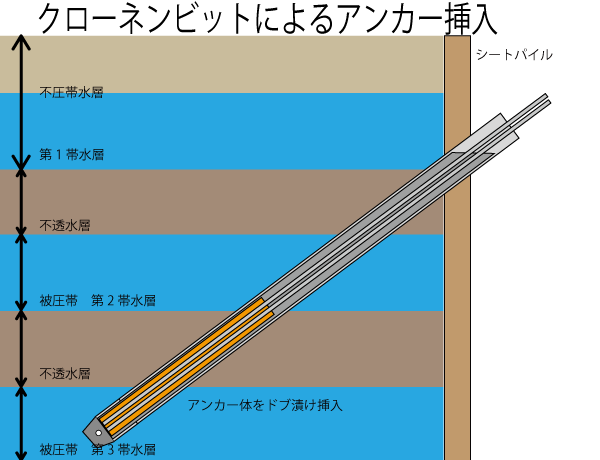 クローネンビットによるアンカー挿入