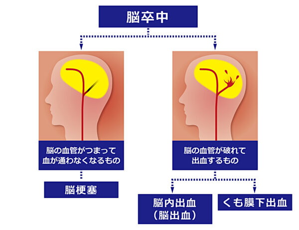 脳卒中