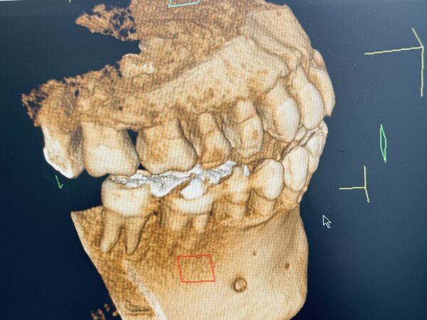 歯のCT写真